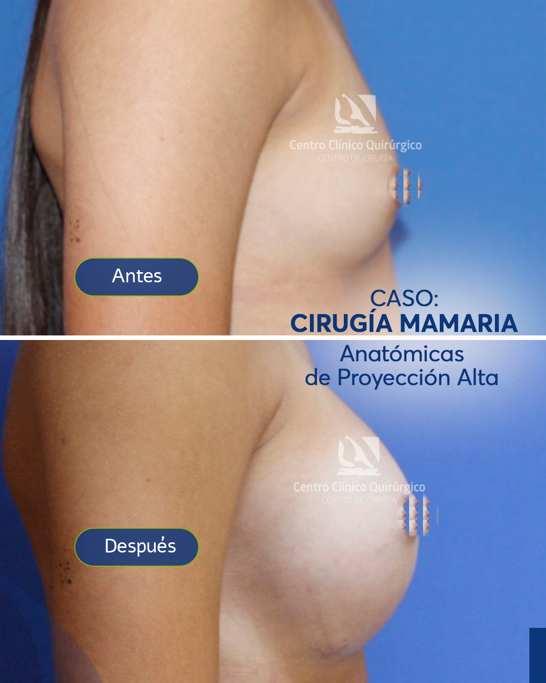 Antes y después implantes anatómicos proyección alta — caso 1