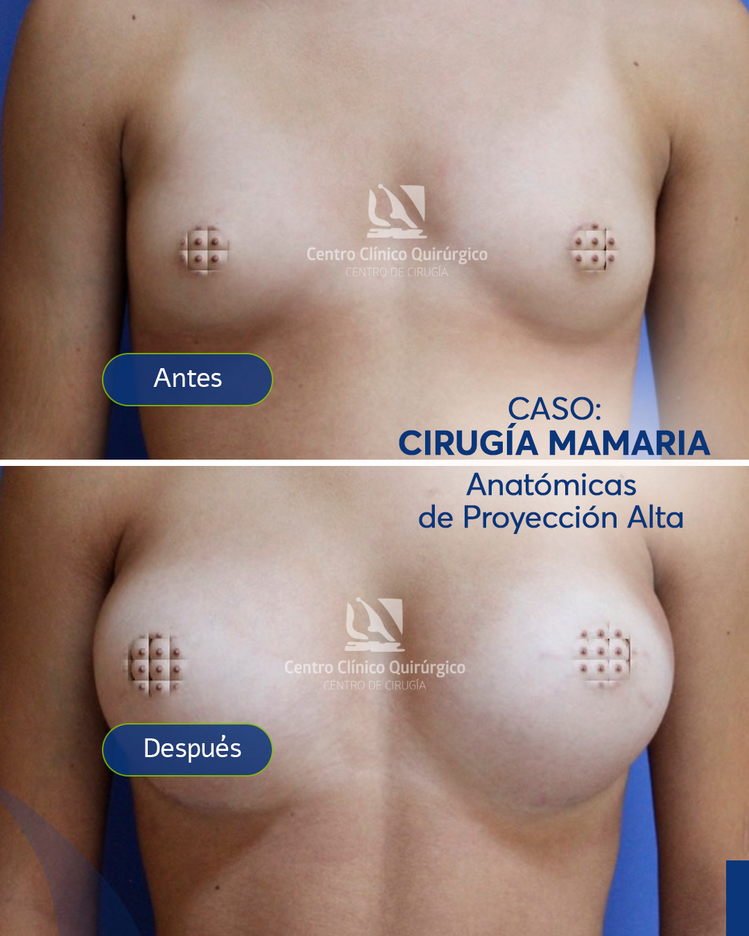 Antes y después implantes anatómicos proyección alta — caso 3