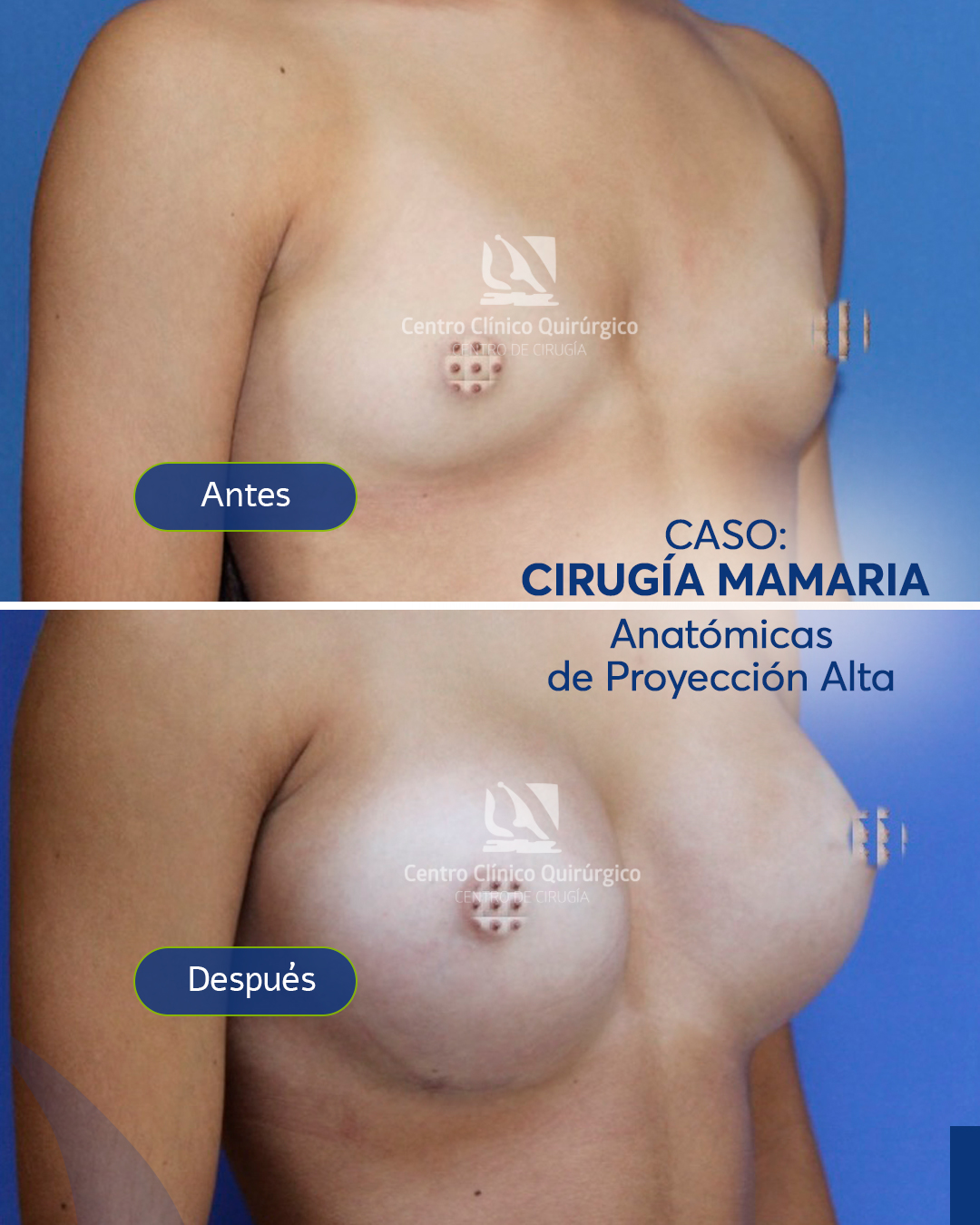 Antes y después implantes anatómicos proyección alta — caso 4