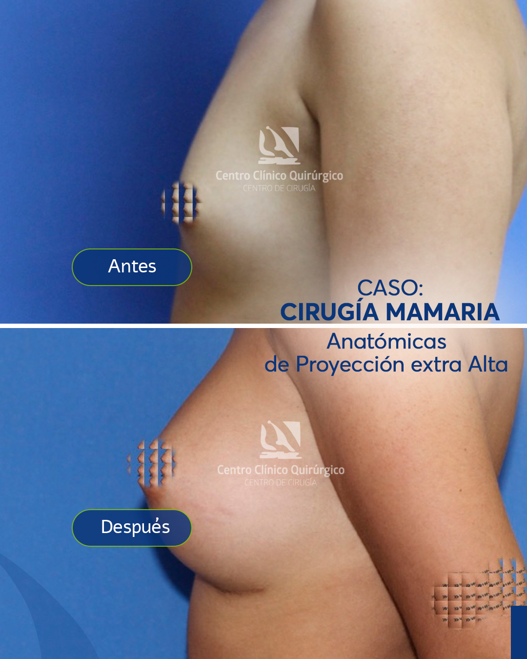 Antes y después implantes anatómicos proyección alta — caso 5