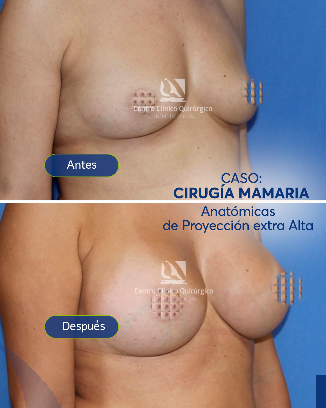 Antes y después implantes anatómicos proyección alta — caso 6