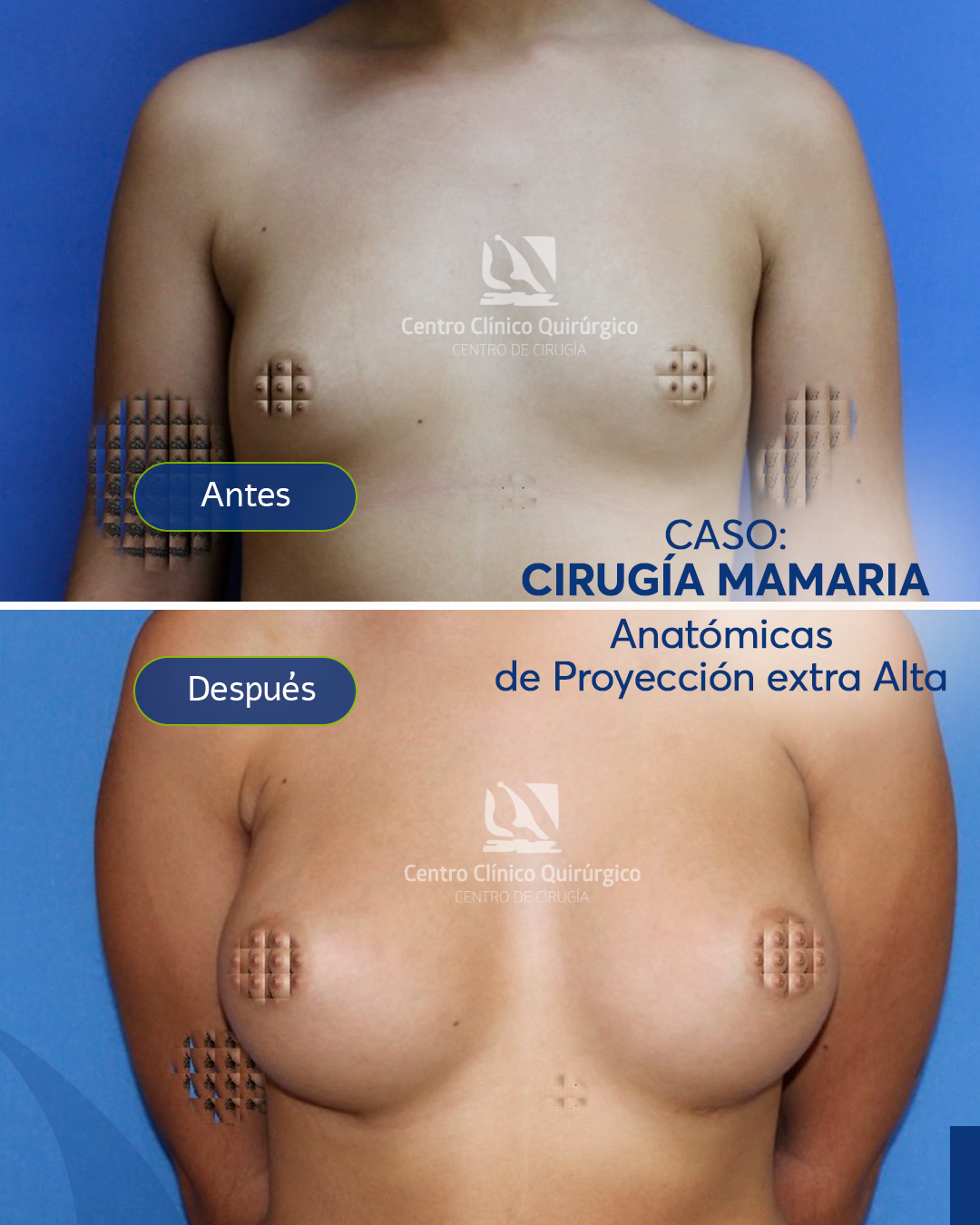 Antes y después implantes anatómicos proyección alta — caso 8