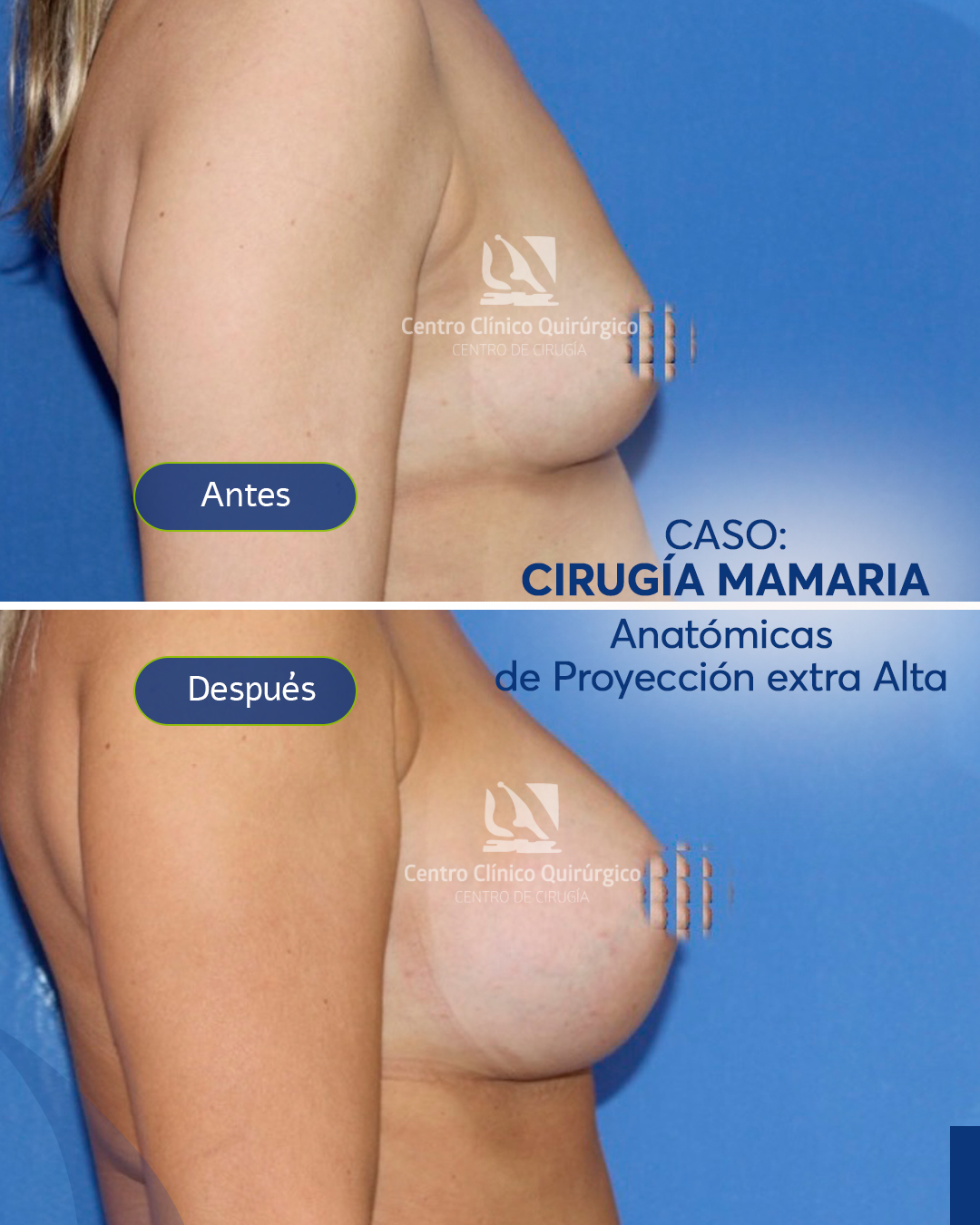 Antes y después implantes anatómicos proyección alta — caso 9