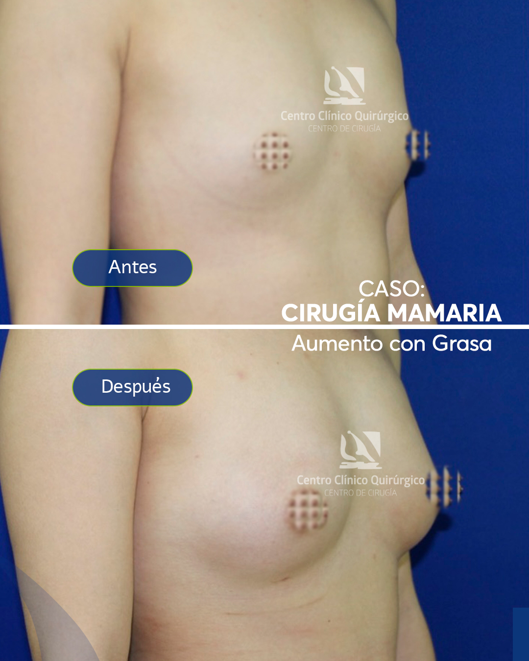Antes y después aumento con grasa propia (lipofilling) — caso 1