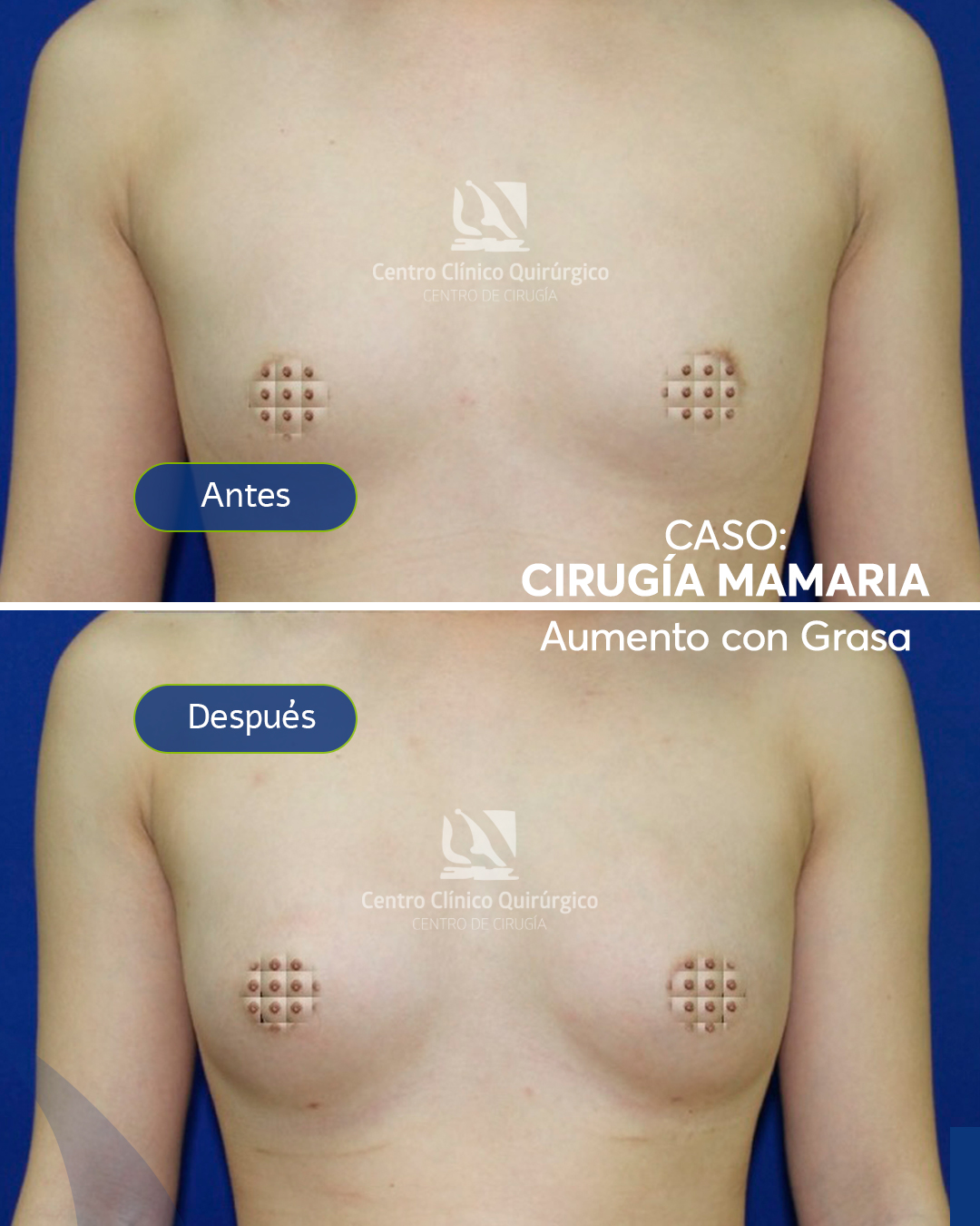 Antes y después aumento con grasa propia (lipofilling) — caso 2