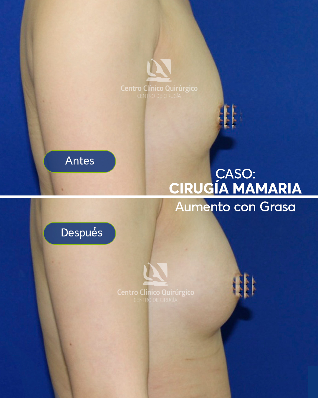 Antes y después aumento con grasa propia (lipofilling) — caso 3