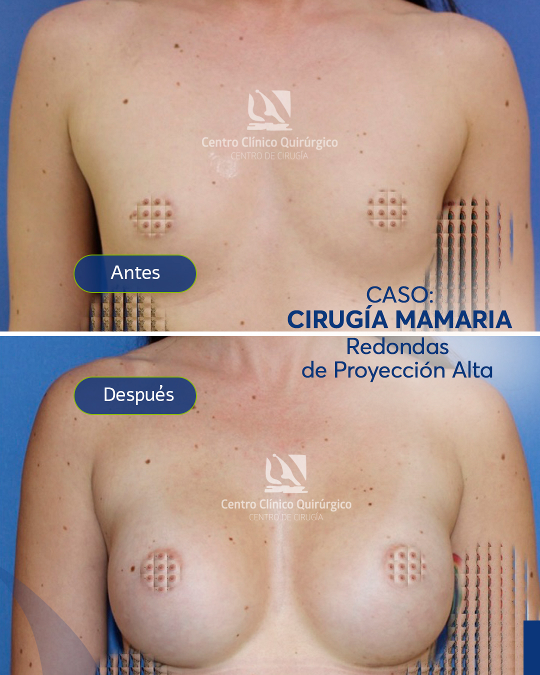 Antes y después implantes redondos proyección alta — caso 1