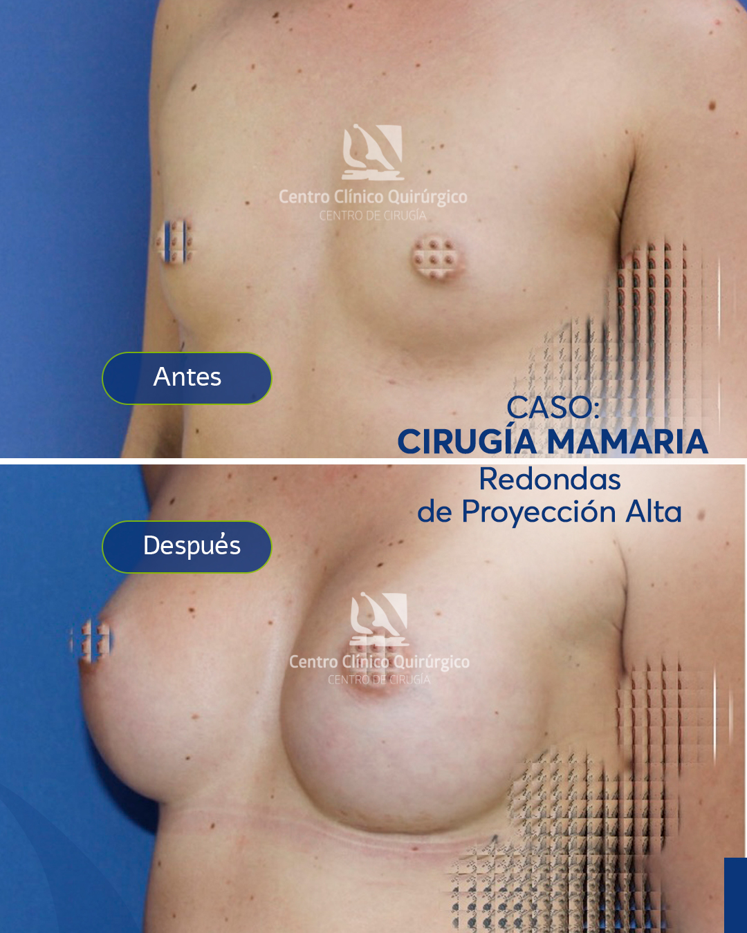 Antes y después implantes redondos proyección alta — caso 2