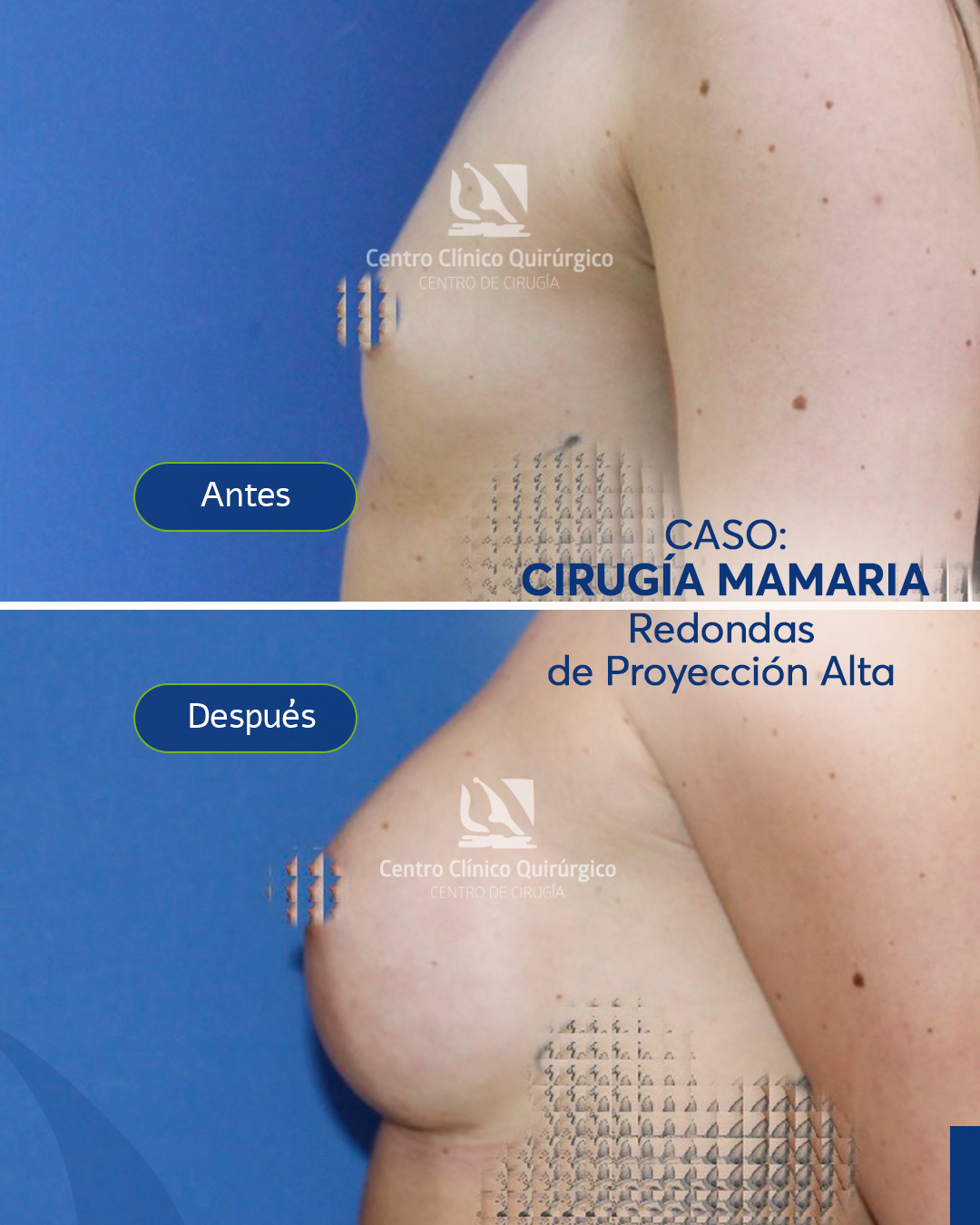 Antes y después implantes redondos proyección alta — caso 3