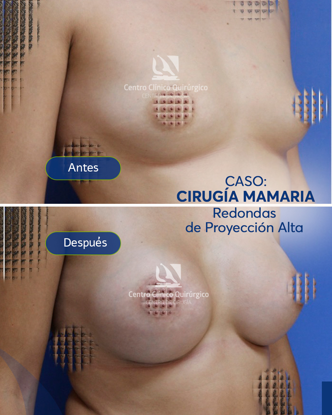 Antes y después implantes redondos proyección alta — caso 4