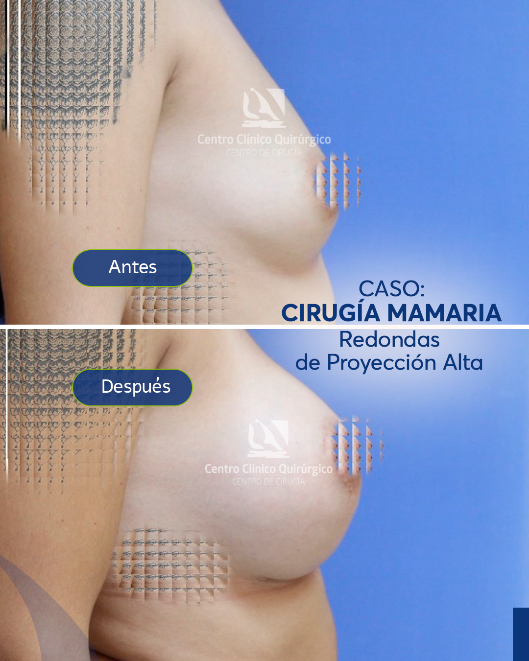 Antes y después implantes redondos proyección alta — caso 5