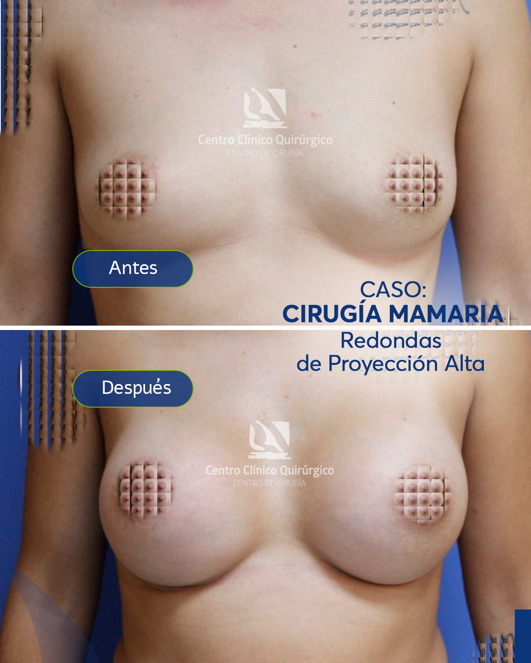 Antes y después implantes redondos proyección alta — caso 6