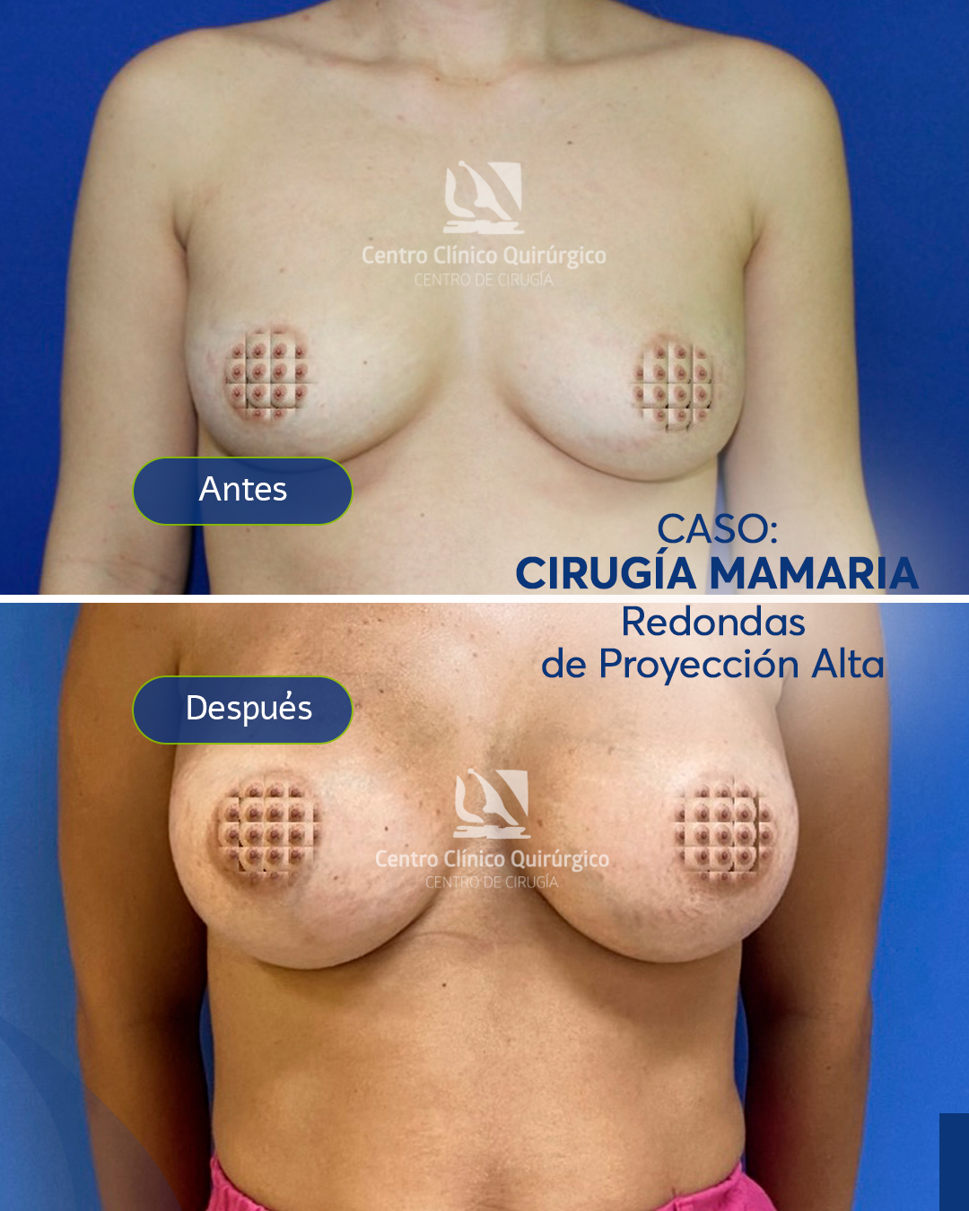 Antes y después implantes redondos proyección alta — caso 7