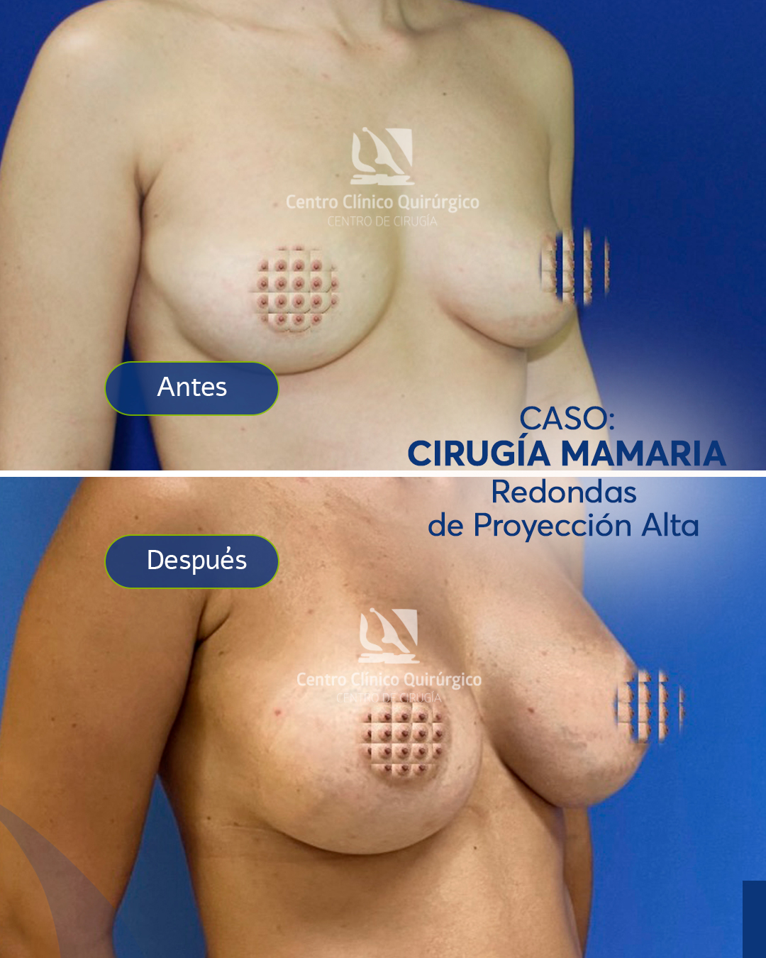 Antes y después implantes redondos proyección alta — caso 8