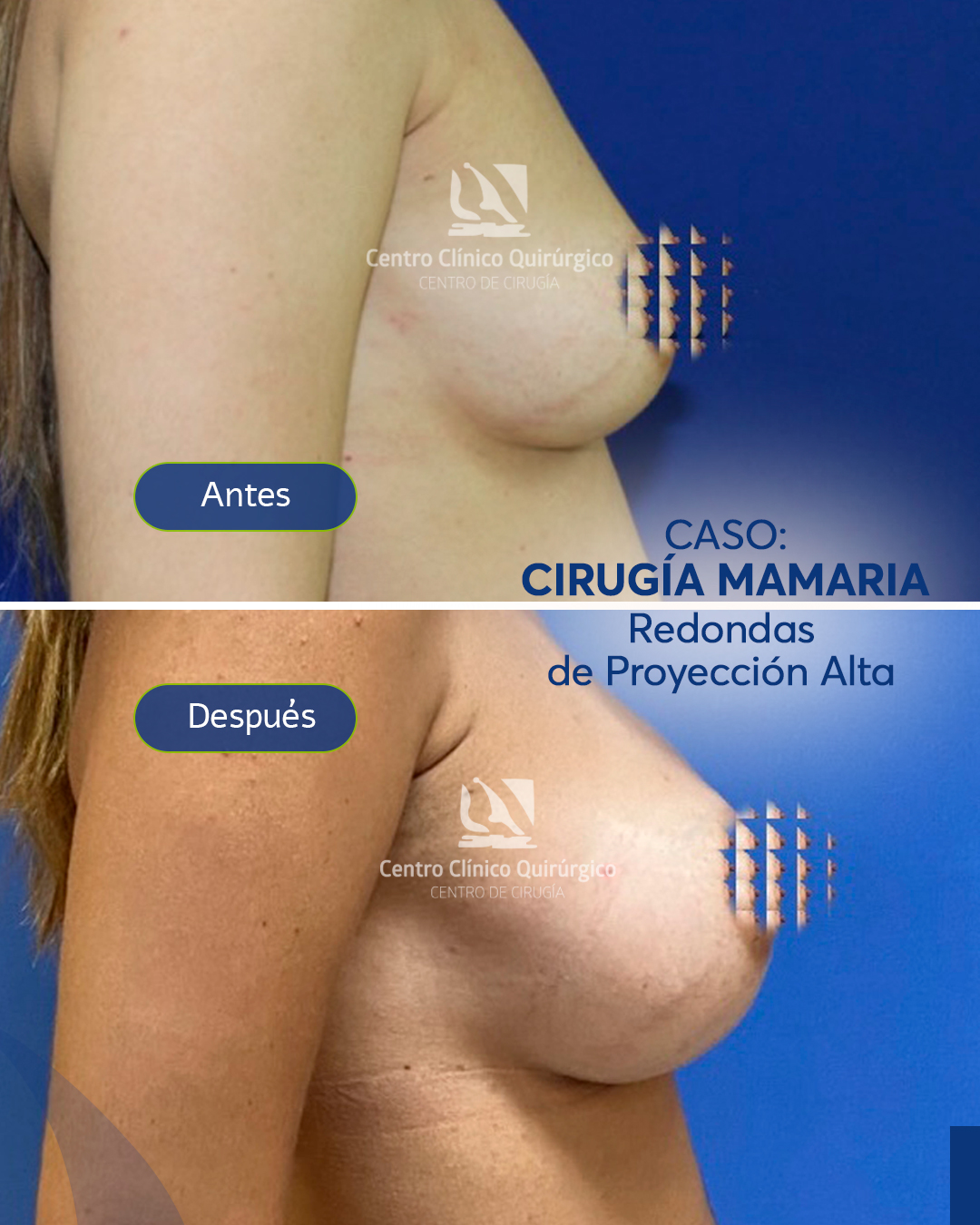Antes y después implantes redondos proyección alta — caso 9
