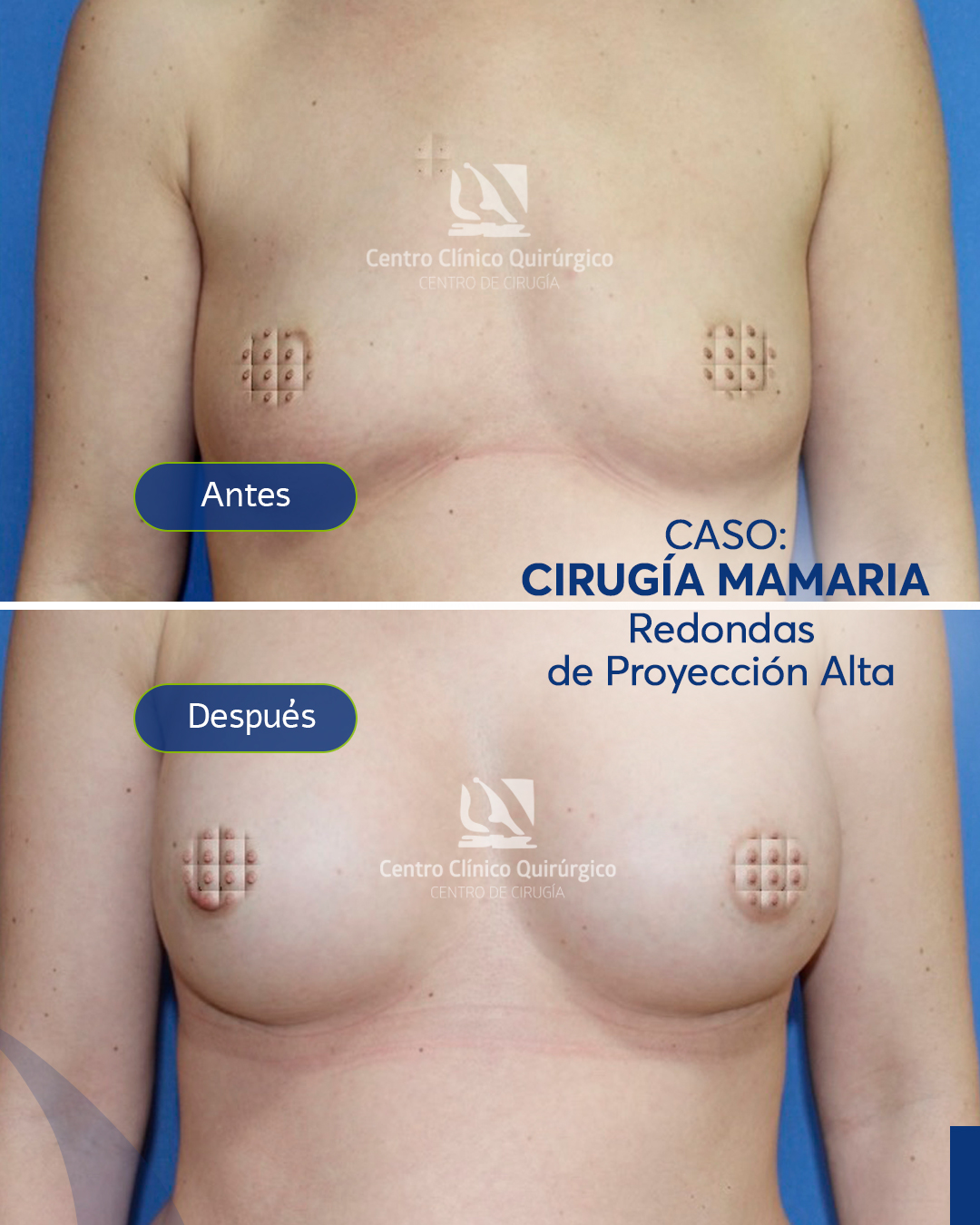 Antes y después implantes redondos proyección alta — caso 10