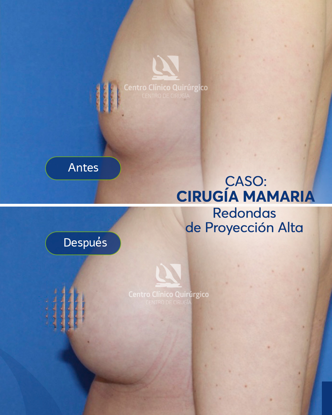 Antes y después implantes redondos proyección alta — caso 12