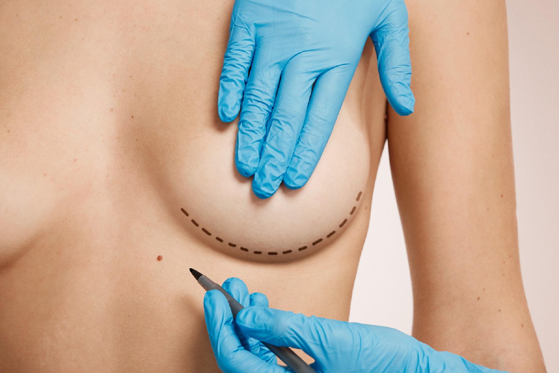 Mujer tras resultado de cirugía estética mamaria